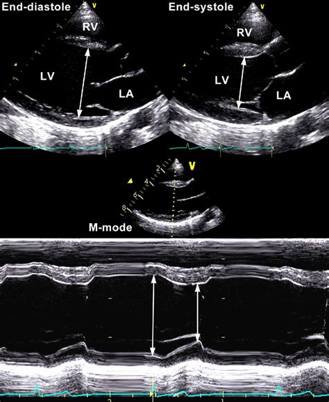 left ventricle thickness measurements|left ventricular size is decreased.